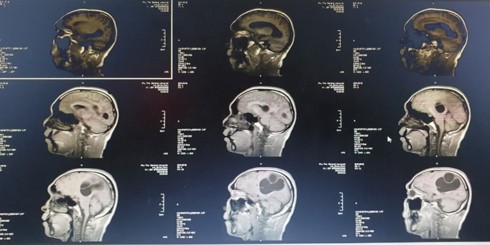 Phẫu thuật ổ sán não khổng lồ trong não nam bệnh nhân