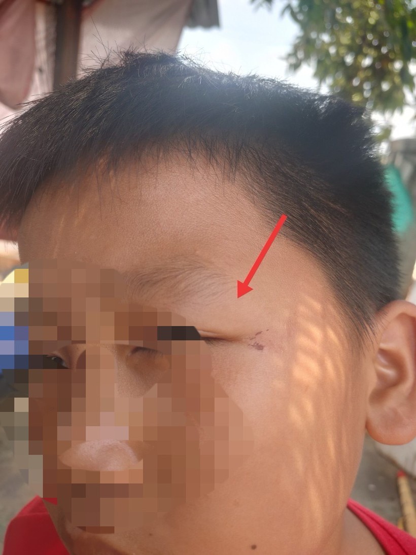 Một cháu nhỏ bị thương ở vùng mặt. (Ảnh: TD)