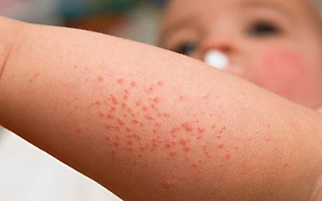 Một số bệnh dịch khác vẫn còn (Covid-19, cúm, thủy đậu…) nên dễ chẩn đoán nhầm với sốt xuất huyết. (Ảnh minh họa)