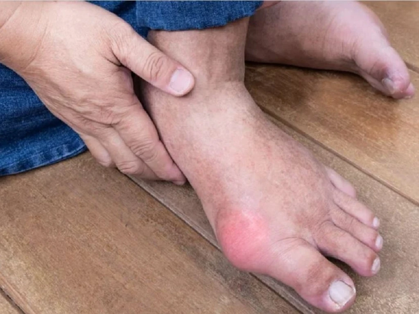 Những cơn viêm khớp gout ban đầu hay gặp ở ngón chân cái, cổ chân, khớp gối. Ảnh minh họa: ITN