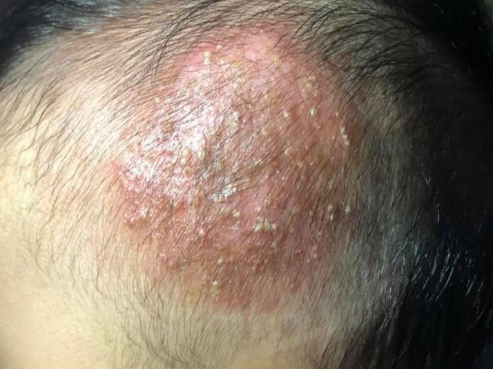 Sau 5 ngày tự điều trị ở nhà, tổn thương ở da đầu bé càng ngày càng lan rộng hơn, sưng nề đỏ, rụng tóc dần. Ảnh: BVCC. 