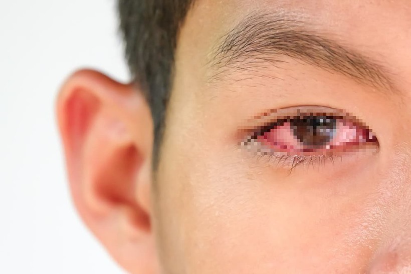 Người bị đau mắt đỏ không nên tự ý dùng thuốc nhỏ mắt có chứa corticoid