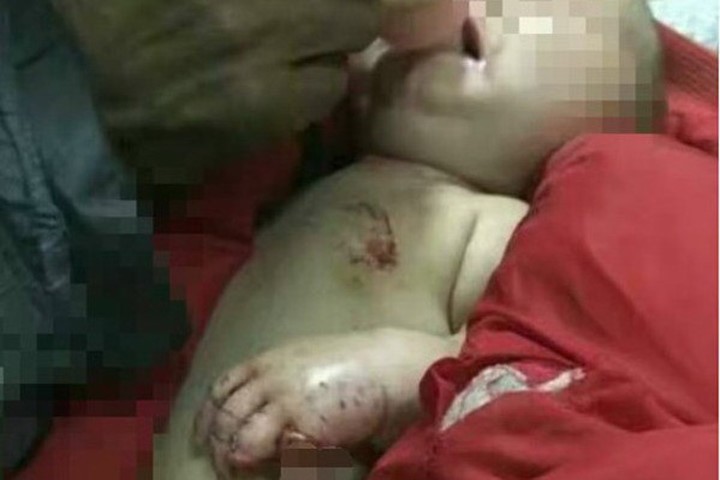 Kinh hoàng: Bé 4 tháng tuổi bị chó cắn rách tai, mất ngón tay khi ở nhà với anh trai 4 tuổi