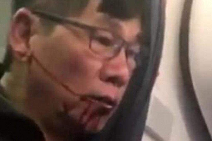 Hình ảnh bác sĩ David Dao, mặt đầy máu sau khi bị hãng hàng không United Airlines dùng vũ lực ép rời khỏi chuyến bay đang gây bão dư luận