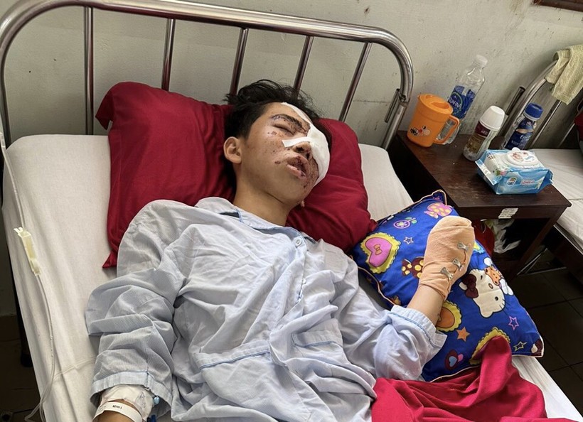 Em Võ Tuấn Tú (lớp 12A7, THPT Hàm Nghi, Hương Khê, Hà Tĩnh) hiện đang điều trị tại Bệnh viện TW Huế.