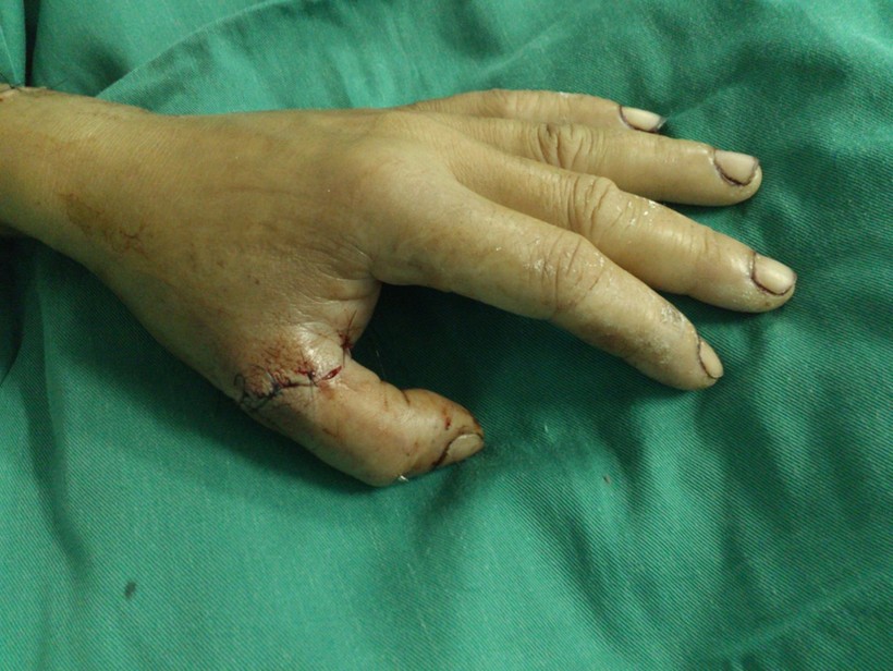 Ca phẫu thuật thành công, ngón tay của bệnh nhân đã bắt đầu cử động được
