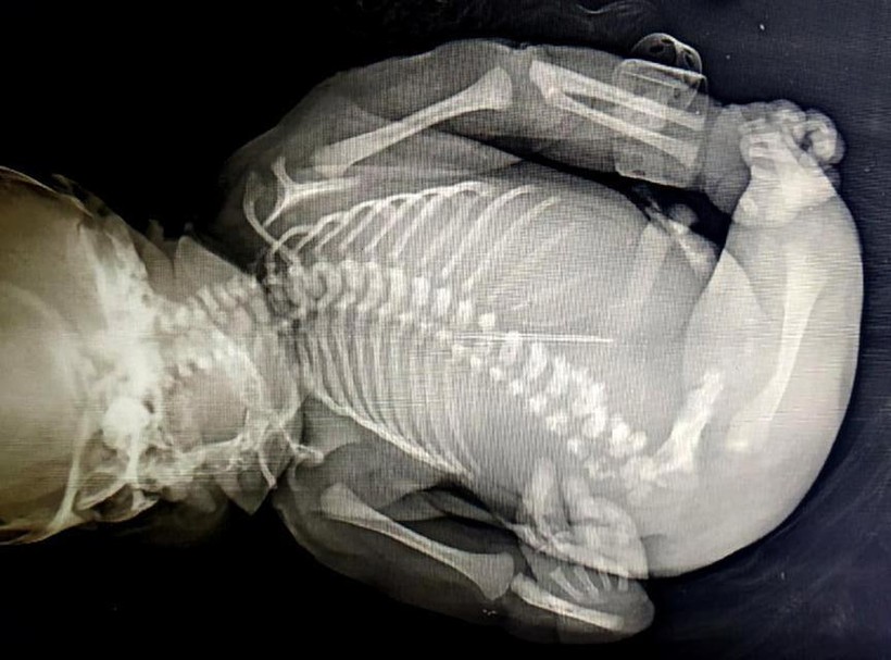 15 phút cuộc đời ngắn ngủi của em bé “người cá” sinh ra tại Ấn Độ