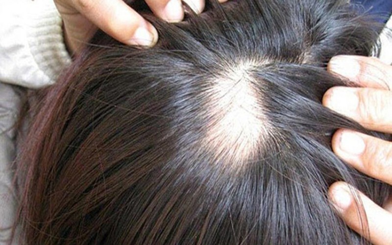 Rụng tóc là một rối loạn xảy ra khi số lượng tóc rụng đi mỗi ngày nhiều hơn số tóc mọc. Trong nhiều trường hợp, tóc sau khi rụng không tiếp tục phát triển, dẫn đến hói hoặc mảng hói.